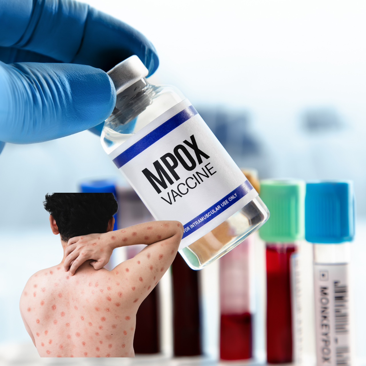 Mpox outbreak declared a global health emergency by the WHO. Learn about the latest developments, sy